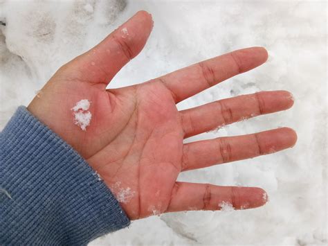 First frostbite treatment approved by FDA .